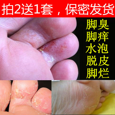 花安乐专治脚气去根神器喷剂脚上长水泡止痒脱皮去烂脚香港脚药膏