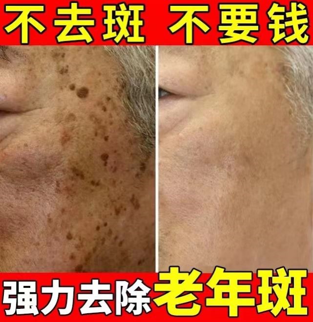 祛斑霜祛黄褐斑老年斑强力去除去老人斑专用药除老年黑班脸上手上