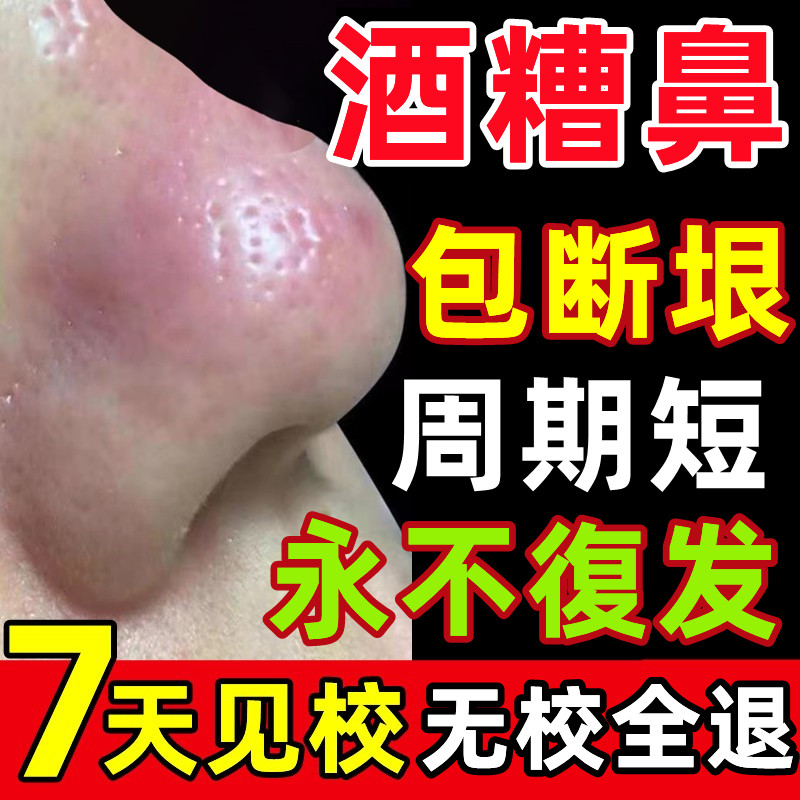 酒糟鼻专用药