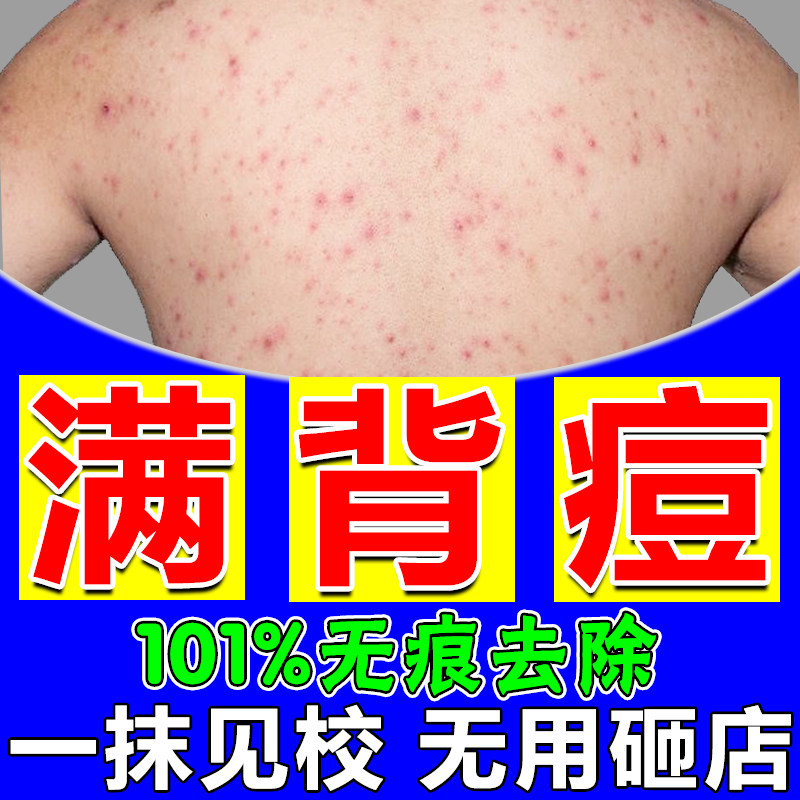 背上长痘痘后背药膏人用胸前脖子祛痘淡化痘印除螨虫止痒抑菌神器