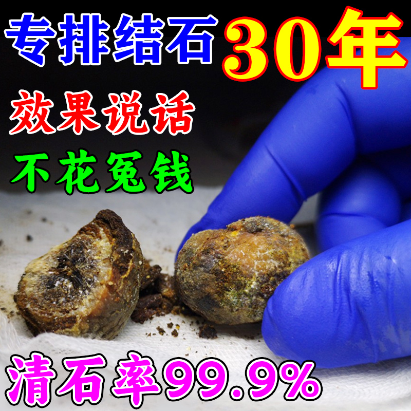 胆结石溶石化石排石专用药治疗胆囊息