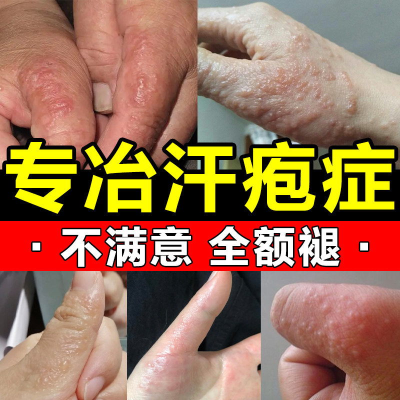 汗泡疱疹药膏儿童手上起小水泡真菌感染手气汉状疱疹专用止痒软膏