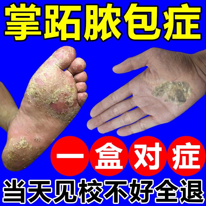 掌跖角化症掌跖脓包毛周角化症掌趾脓疱手脚蜕皮干裂角皮外用药膏