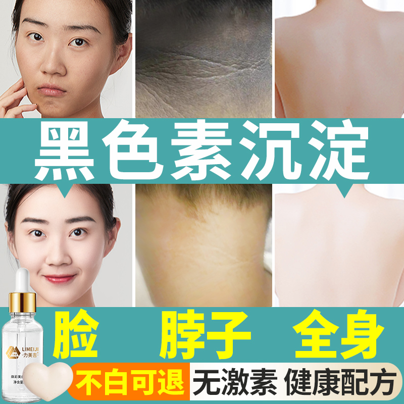 脖子黑颈部黑色素沉淀怎么办洗不干净美白黑棘皮变白非去除非神器