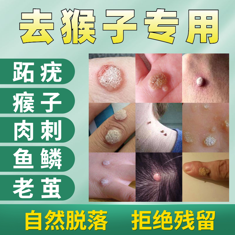 跖疣尤血包刺肉刺瘊子熬病毒疣鱼休子鸡眼膏贴治疗脚疔药-怎么样-图片