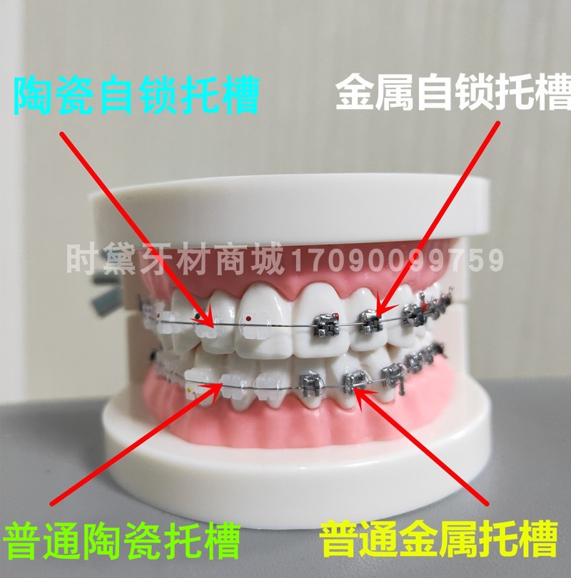 口腔门诊医患沟通讲解练习用正畸模型 金属陶瓷自锁托槽对比模型