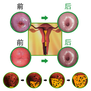 有炎症的宫颈口图片图片