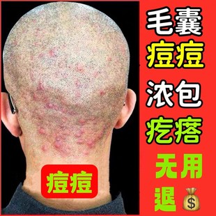 网红头皮毛囊炎专用药头部头上后背背部手长痘痘头痒有疙瘩毛囊炎