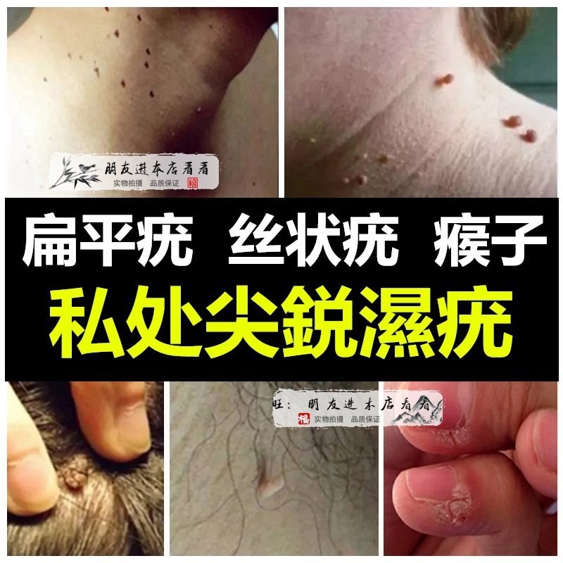 清忧丝状猴子肉粒滴优去尤灵美浮特皮肤凝胶中玉猫