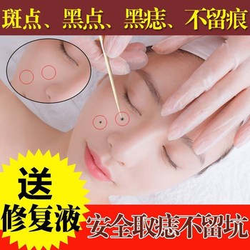 点痣药水无痕疣子