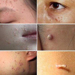 扁平疣去除男女性脸上面部身体病毒疣手上瘊子背部水猴子膏尤