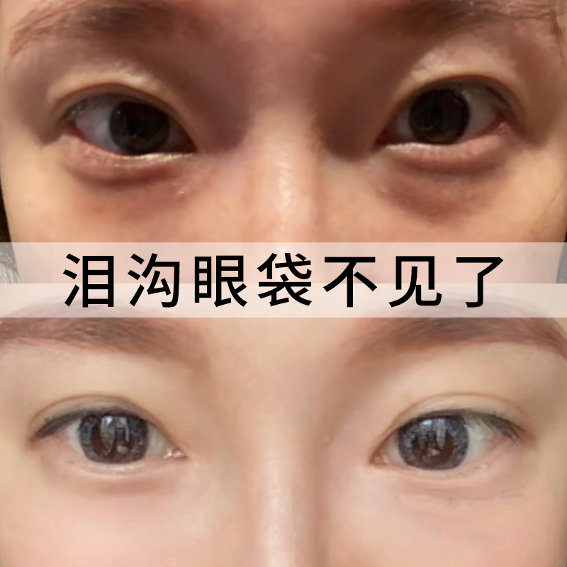 眼周一周三盒精华液丰盈眼袋小红泪沟告别推荐液态精华