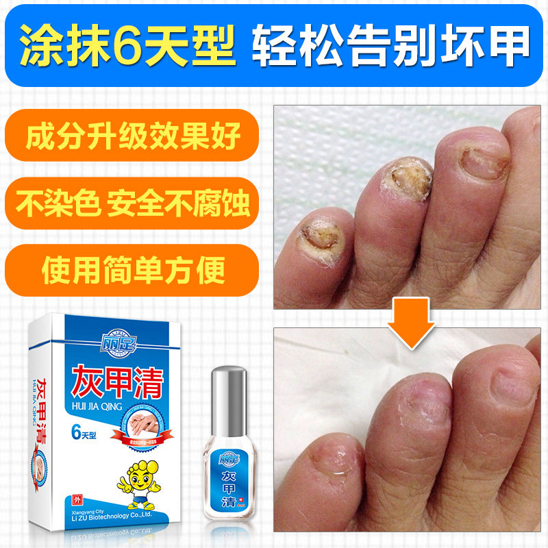 【丽足】灰甲清灰指甲治疗专用