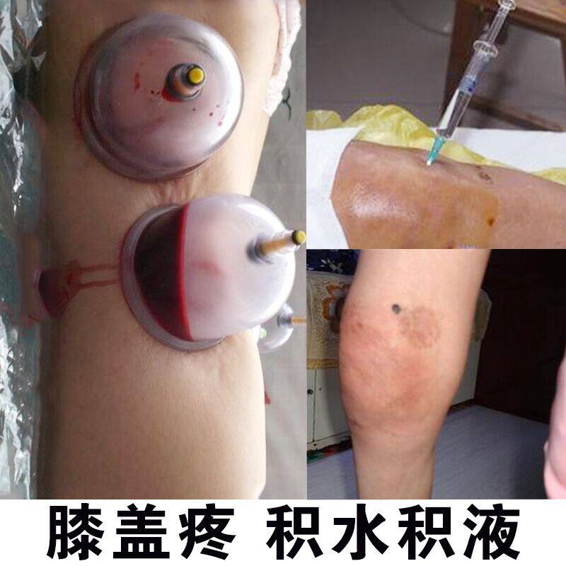 滑膜贴膝关节积液积水半月板撕裂膏贴膝盖痛神器膝盖疼痛贴净消膏