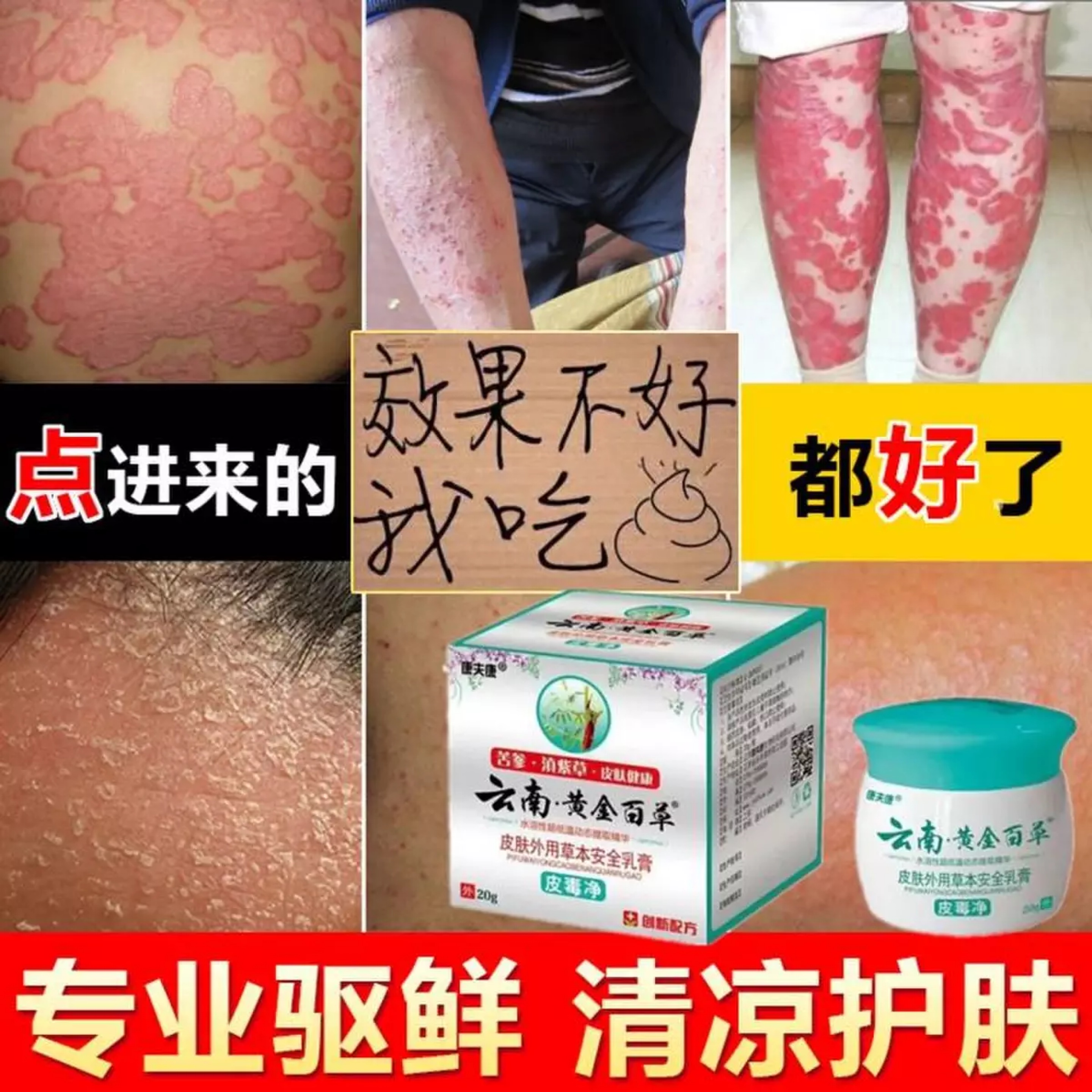 皮肤瘙痒_治疗牛皮藓头皮癣银屑病廯湿疹皮肤瘙痒过敏红疹止痒去根
