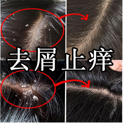 洗头膏 洗发水 去屑 头皮屑大额优惠券