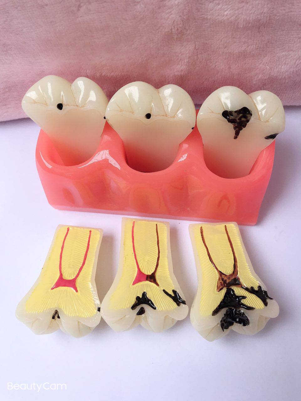 牙科口腔教学模型分半饰品讲解沟通摆件大齿科牙医材料 蛀齿模具