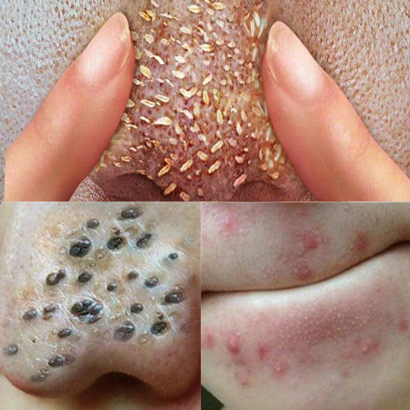 除螨螨虫去螨深层清洁告别身体脏兮兮鞋袜除臭剂