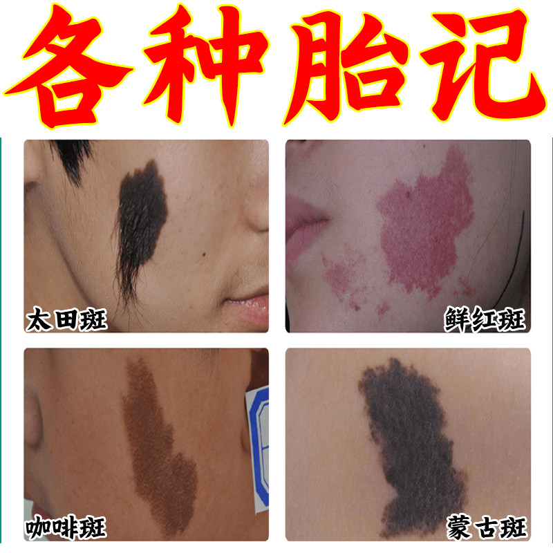 去胎记-特价促销-优惠券领取-价格|多少钱|什么牌子好-35优惠券网站