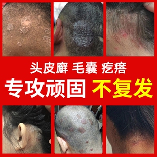 2治头皮屑的牛皮癣买止痒藓天山毒癣王药膏毒藓王鲜王藓王江西灵