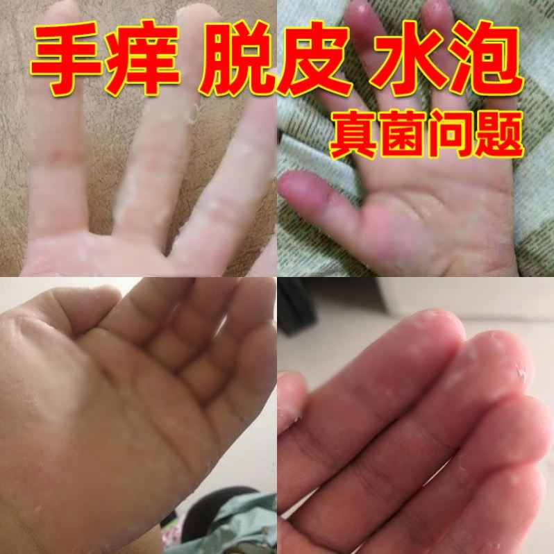 手足癣药膏儿童皮肤手藓手气膏真菌感染喷雾苗族药膏老偏方药膏