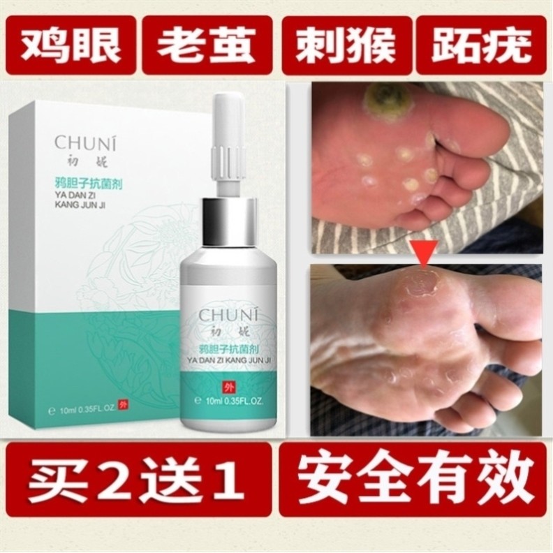 鸡眼膏特效药脚趾正品药膏去鸡眼神器刀挖专用跖疣修脚四肢脚垫