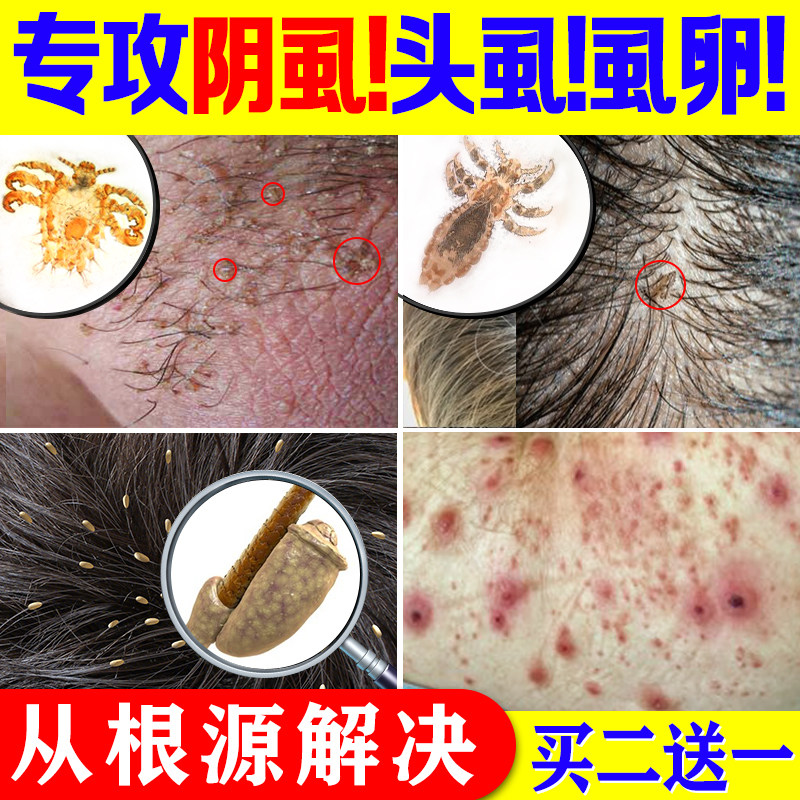 同宗堂男女艾万克净毛露抑菌液除阴虱体虱头虱虱卵跳蚤成人一扫光