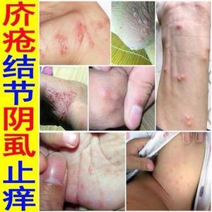 专治疗疥疮膏特效药结节性硬块痘痘皮肤瘙痒全身止痒干疮麻疹断根