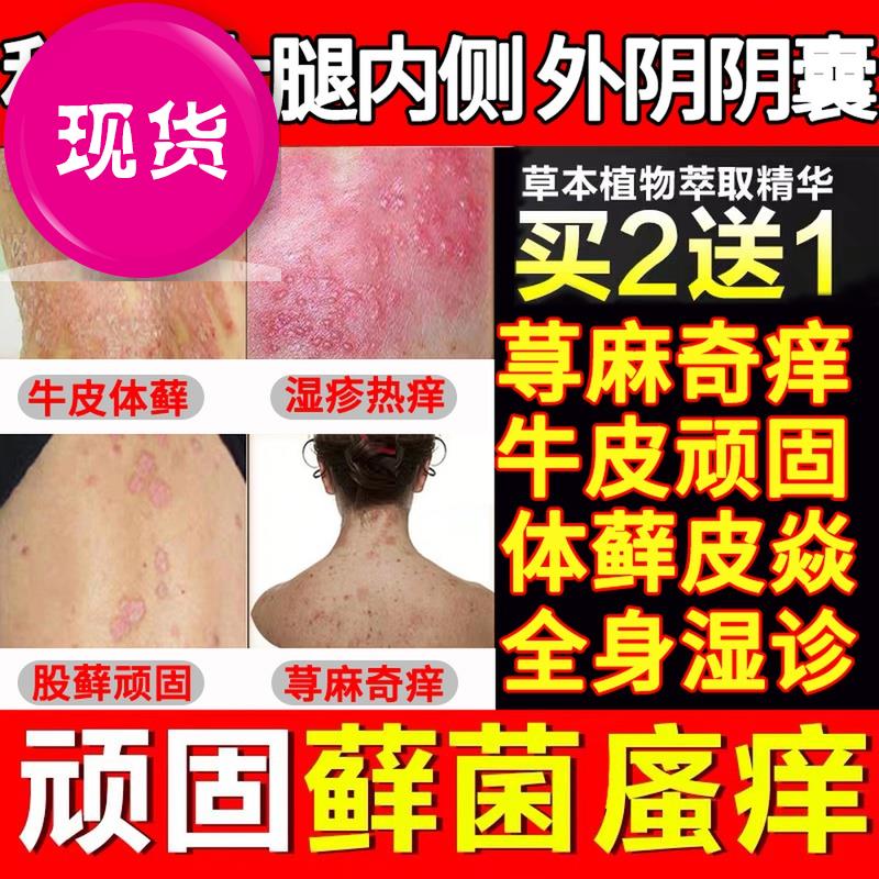 百毒奇癬膏黃體酮軟1膏百庠王七檸寸拔癬膏疥滇檸南奇草狼檸毒黃在類目 五金/工具, 施工保護, 繩網, 體育網/圍網中 - 來自Buy2taobao.com提供專業的淘寶代購服務