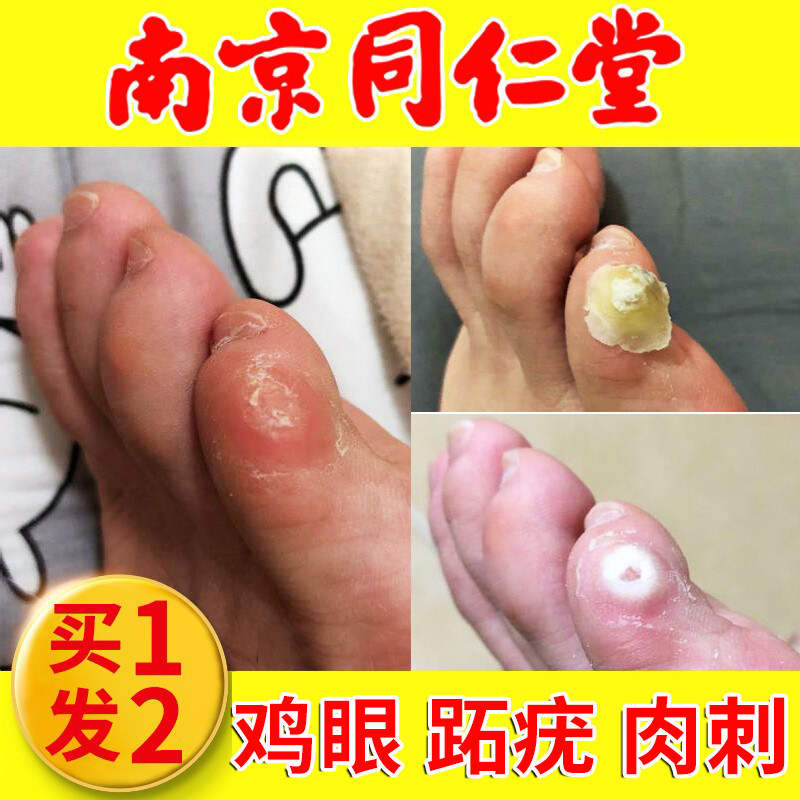 南京同仁堂鸡眼贴膏鸡贴眼鸡跖疣肉刺瘊子脚底老茧尤平净专用正品