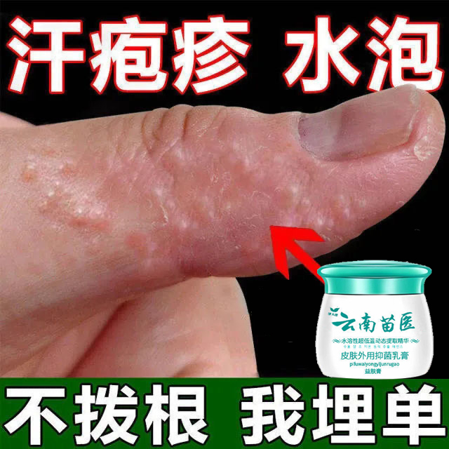 汗疱疹手癣膏手足藓真菌感染脱皮干裂水泡手气鹅掌风汗状疱疹药膏