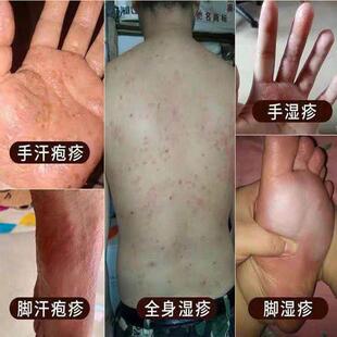 疹止疱去根慢lvg性顽固水痒痒泡手外足用手药汗疹湿汗状疱疹专用