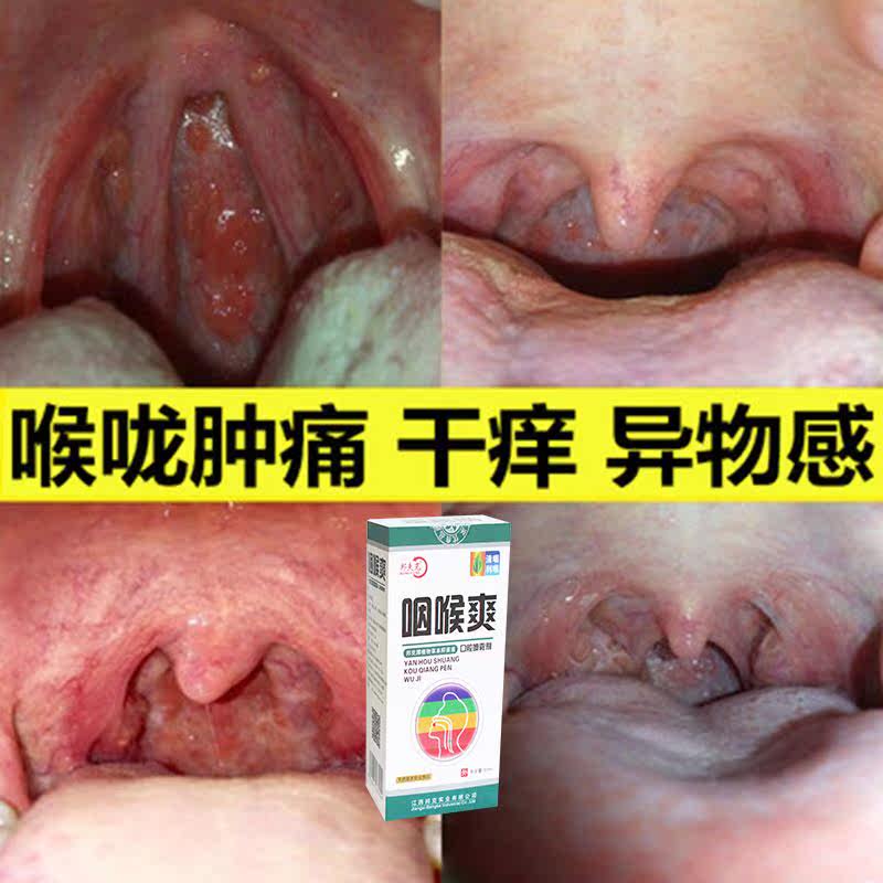 咽炎慢性根治咽喉炎异物感干痒嗓子疼肿痛通用除根神器