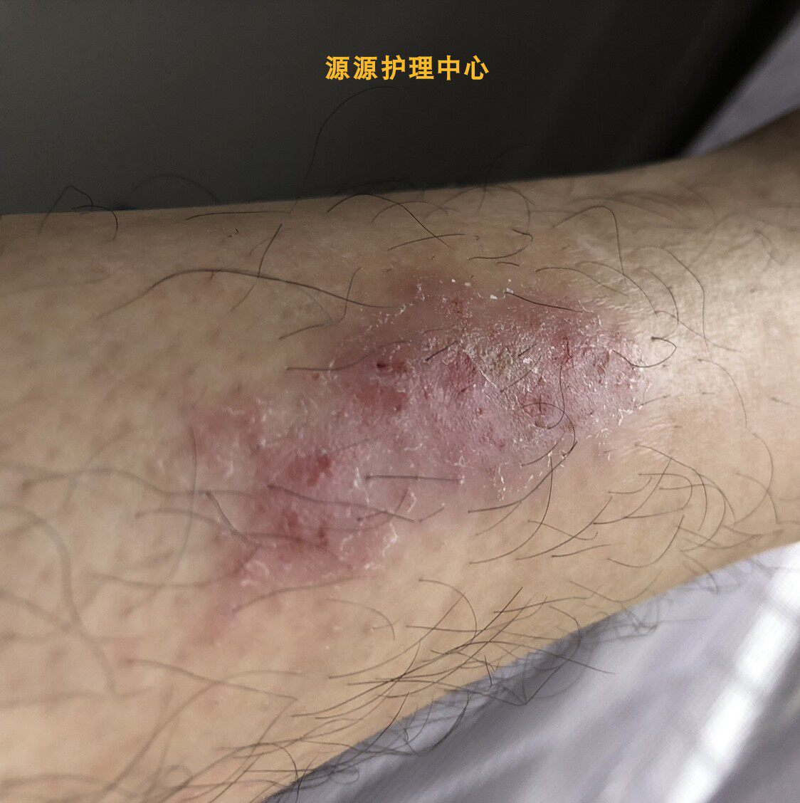 源源护理中心草本癣克宁药膏牛皮癣银屑癣头皮藓手足癣股癣外用药膏