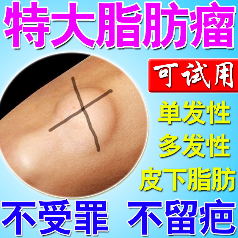脂肪瘤药消瘤膏粉瘤皮脂腺囊肿皮肤纤维瘤去除多发性单发性多发性