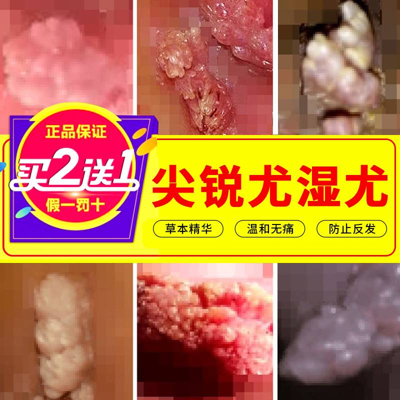 尖锐湿疣膏正品特傚男性女性私处干扰素鬼臼毒素酊防复发中药肛门