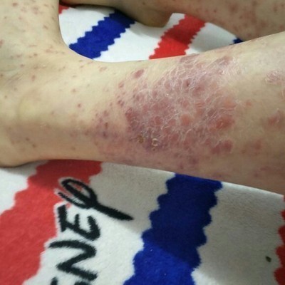 皮肤干燥痒藓霸牛皮癣芙必治万毒膏草本药膏18g手足牛皮痒藓手脚