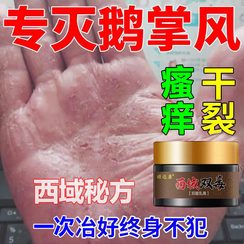 一折手干裂膏特效_特效膏】鹅掌风干裂脱皮手藓鹅掌风真菌感染手足