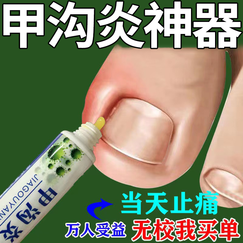 甲沟炎专用药脚指甲发炎疼痛非矫正器神器消肿去肉芽软化脱甲治疗