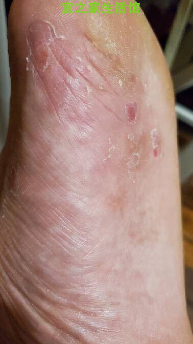 脚板心痒脚气鼎医盛品蛇蝎九毒王抑菌药膏草本外用防伪标包邮【买