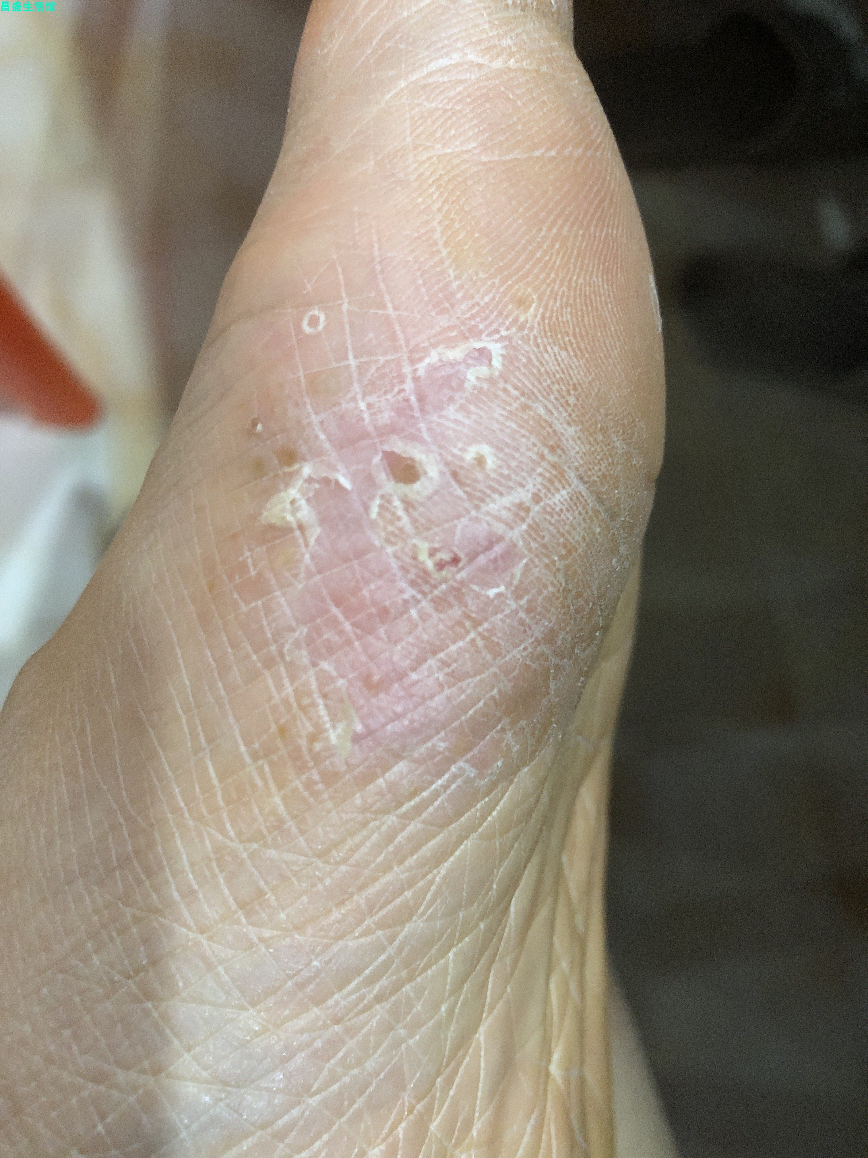 治脚痒水泡脱皮脚气祺臻癣毒灵抑菌药膏(买2送1买3送3)成人外用