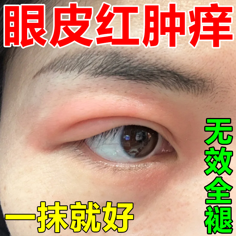 眼皮红肿痒过敏干燥消肿眼睛癣周围过敏眼角止痒消肿保湿修复药膏