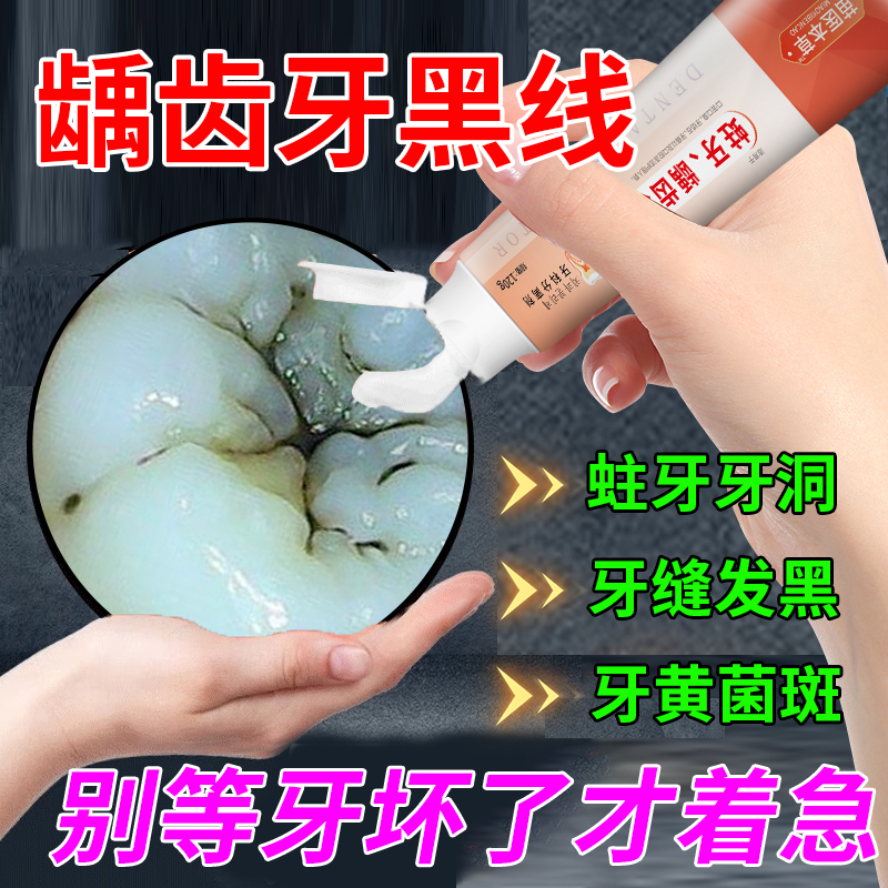 牙齿缝隙黑去牙斑菌牙膏有牙黑线牙黑斑去除清除牙菌斑修复浅龋RQ