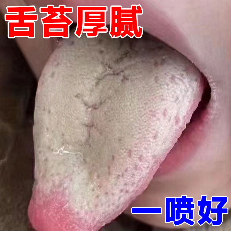 【100％拔裉】舌苔厚白厚黄腻调理