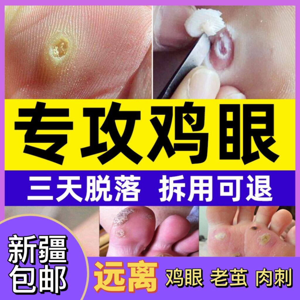 新疆包邮鸡眼贴鸡眼膏足部脚底脚趾手部鸡眼药去除老茧肉刺神器