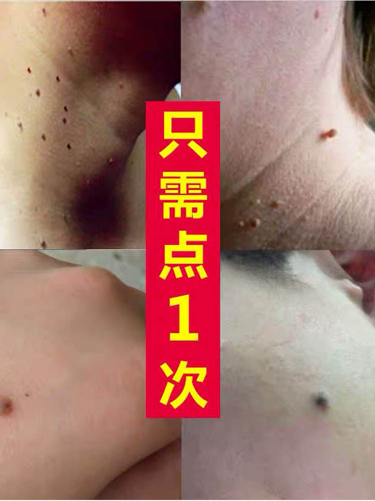 搜索"痣无痕"的优惠券结果页-搜券网