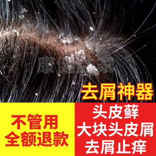 头皮护理清洁头皮藓抗真菌癣去大块头皮屑神器去屑止痒洗发水正品