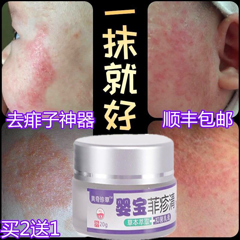 痱疹清痱子膏去痱止痒膏热痱婴幼儿宝宝儿童成人袪痱蚊子叮咬神器