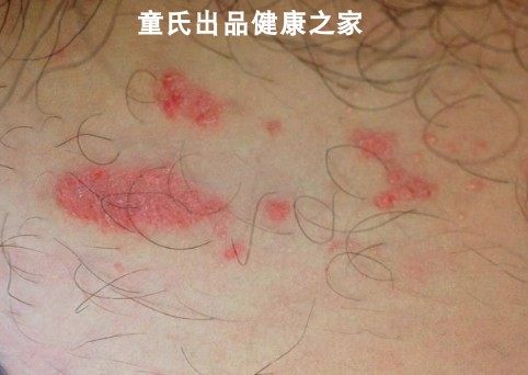 屁股痒止痒膏_屁股起痘痘牛皮癣股藓佰草良方药膏15g止痒诗莱格膏老庄