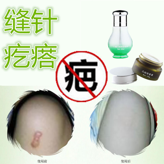 奇迹草液去手术产后增生性凹凸疤冻疮疙瘩开刀割伤巴痕灵烟烫药液在类目 彩妆/香水/美妆工具, 遮瑕中 - 来自Buy2taobao.com提供专业的淘宝代购服务